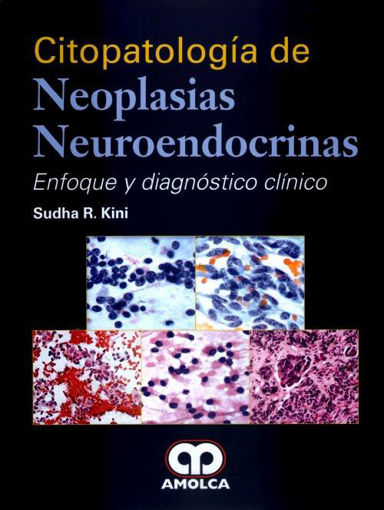 Imagen de Citopatología de neoplasias neuroendocrinas Enfoque y diagnóstico clínico