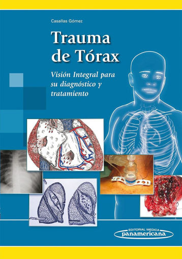 Imagen de Trauma de torax