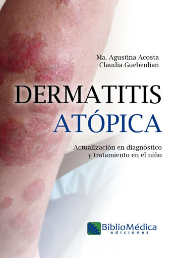 Imagen de Dermatitis atópica