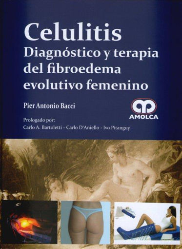 Imagen de Celulitis Diagnóstico y terapia del fibroedema evolutivo femenino