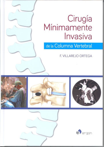 Imagen de Cirugía mínimamente invasiva de la columna vertebral