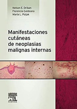 Imagen de Manifestaciones cutáneas de neoplasias malignas internas