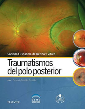 Imagen de Traumatismos del polo posterior