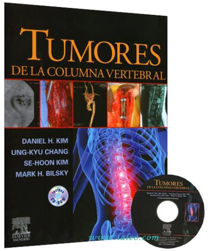 Imagen de Tumores de la columna vertebral