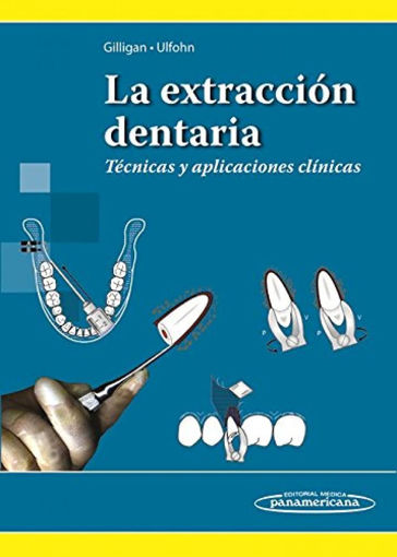 Imagen de La extracción dentaria