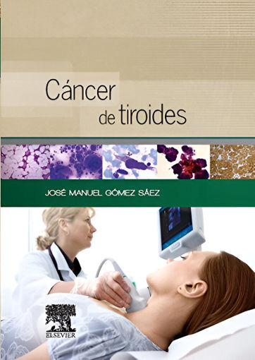 Imagen de Cáncer de tiroides