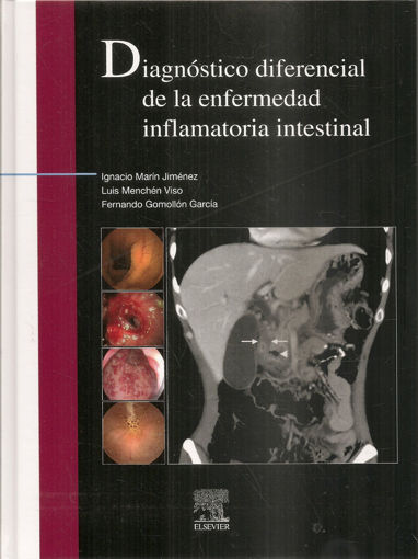 Imagen de Diagnóstico diferencial de la enfermedad inflamatoria intestinal